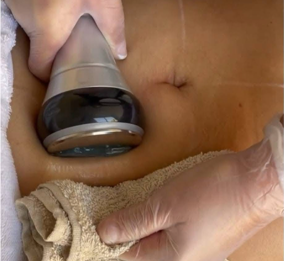 Body Contouring – Sesión Individual