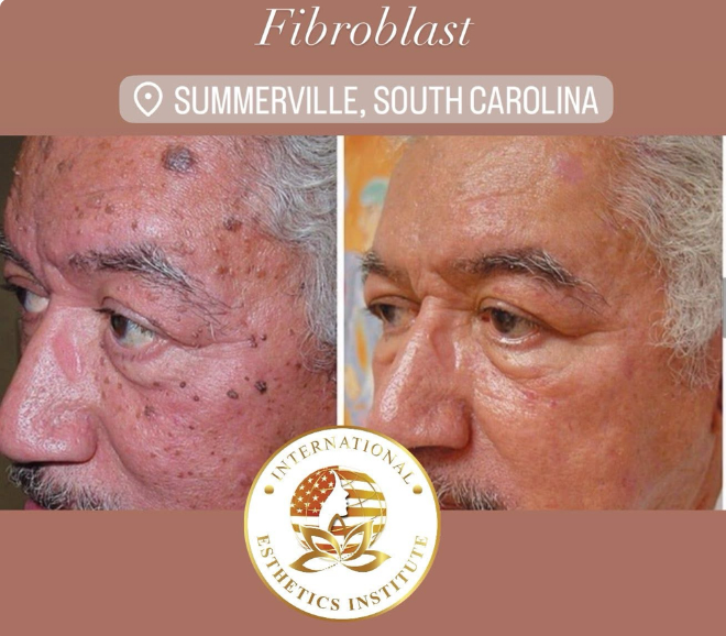 Fibroblast Facial - Cara y Cuello