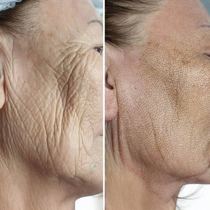 Fibroblast Facial - Cara y Cuello